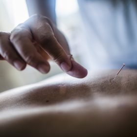 Hanoi,Vietnam,Close up of hand holding fine needle, performing acupuncture on a patient's back